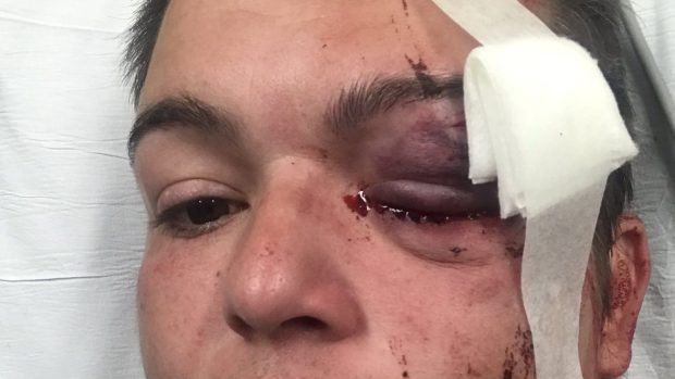 Linda Tirado Shot In The Eye By Police